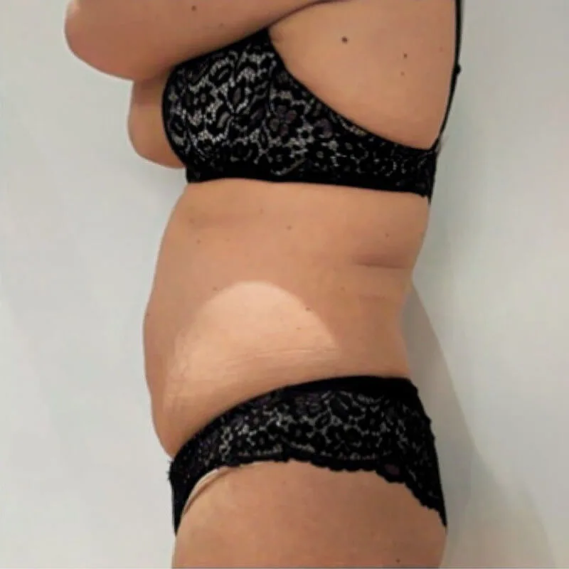 Buikomvang verminderd na 3 keer een cryolipolyse behandeling