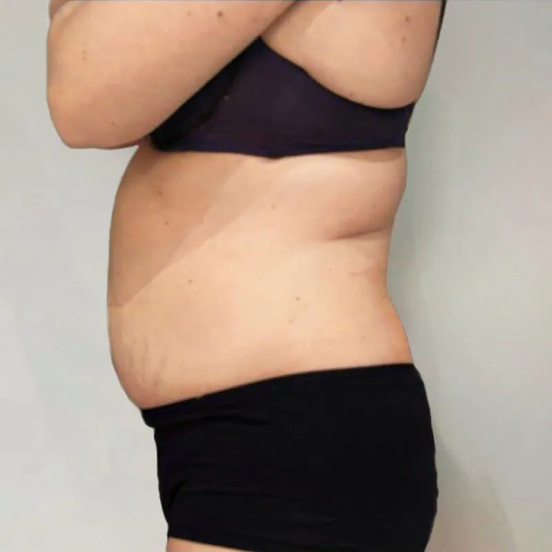 Buik van een vrouw vóór een cryolipolyse behandeling gericht op het verminderen van overtollig buikvet.