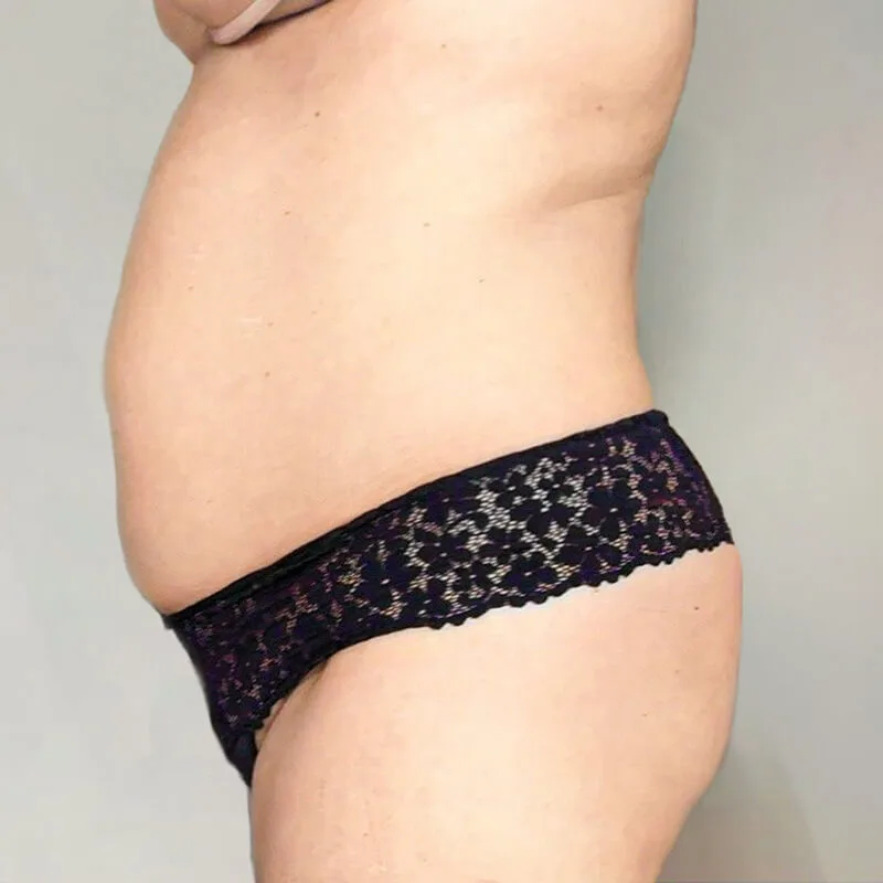 Vrouwelijke buik voorafgaand aan een cryolipolyse behandeling voor het verminderen van buikvet