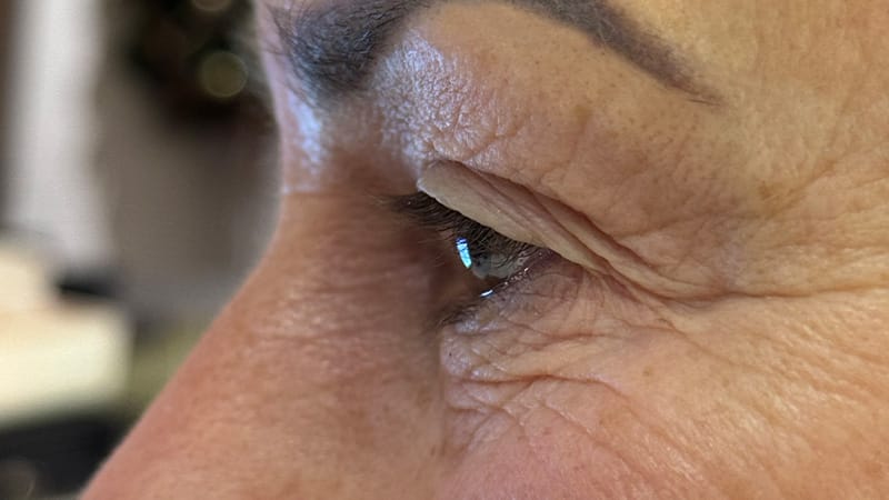 Ooglidcorrectie zonder operatie voor foto