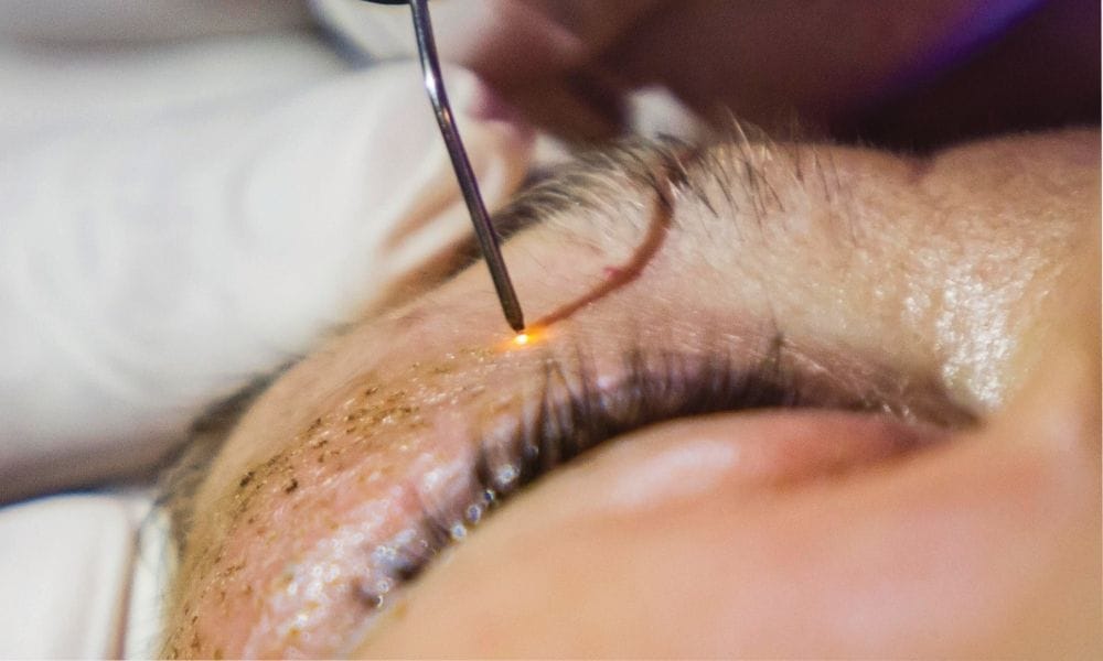 ooglidcorrectie met plasmage