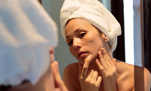 Acne littekens verminderen door het gebruik van huidverzorging