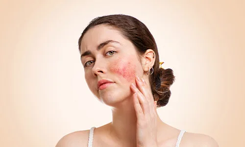 Behandeling voor het verwijderen van couperose in het gezicht voor een egalere teint