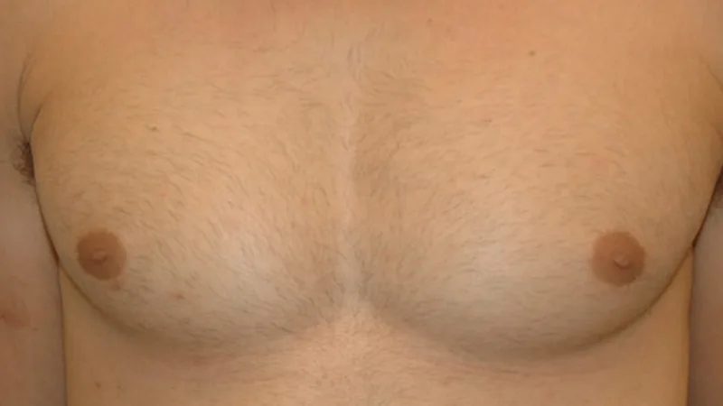 Definitief ontharen van de borst van de man na foto