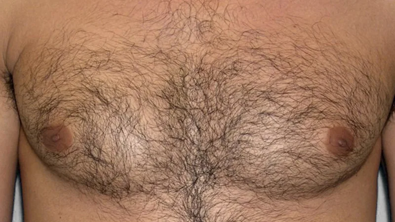 Definitief ontharen van de borst van de man voor foto