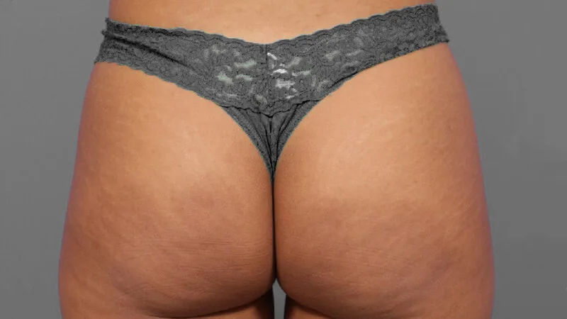 Cellulite verwijderen na de behandeling