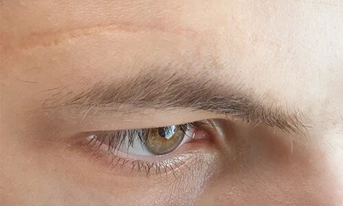 Littekens in het gezicht van een man