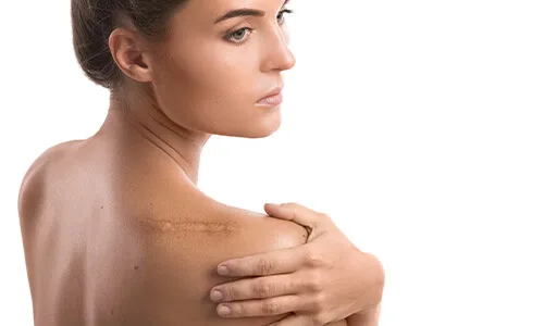 Littekens verminderen doormiddel van de microneedling rf