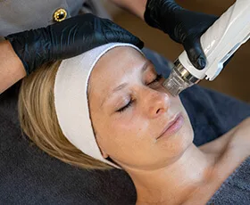 Microneedling RF-behandeling voor het effectief verstrakken van de huid