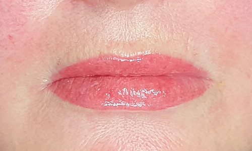 Lippen na de behandeling
