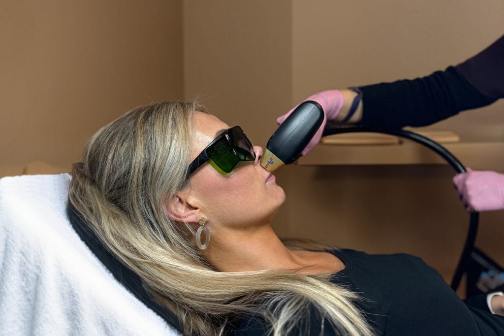 Laserbehandeling voor het ontharen van de bovenlip