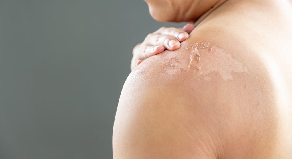 Verbrande huid door de zon