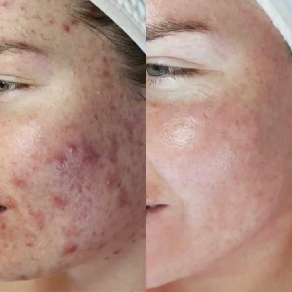acne-voor-na-led-therapie