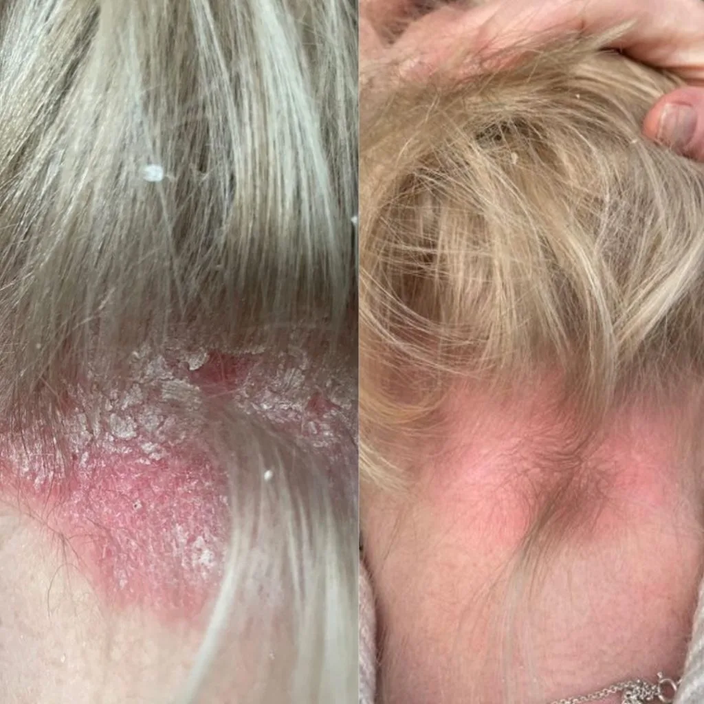 psoriasis voor na dermalux led therapie