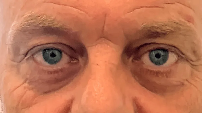 Resultaat van gelifte oogleden na de behandeling voor een frissere uitstraling