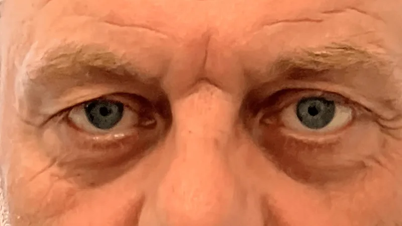 Oogleden voorafgaand aan de behandeling, met zichtbare verslapping