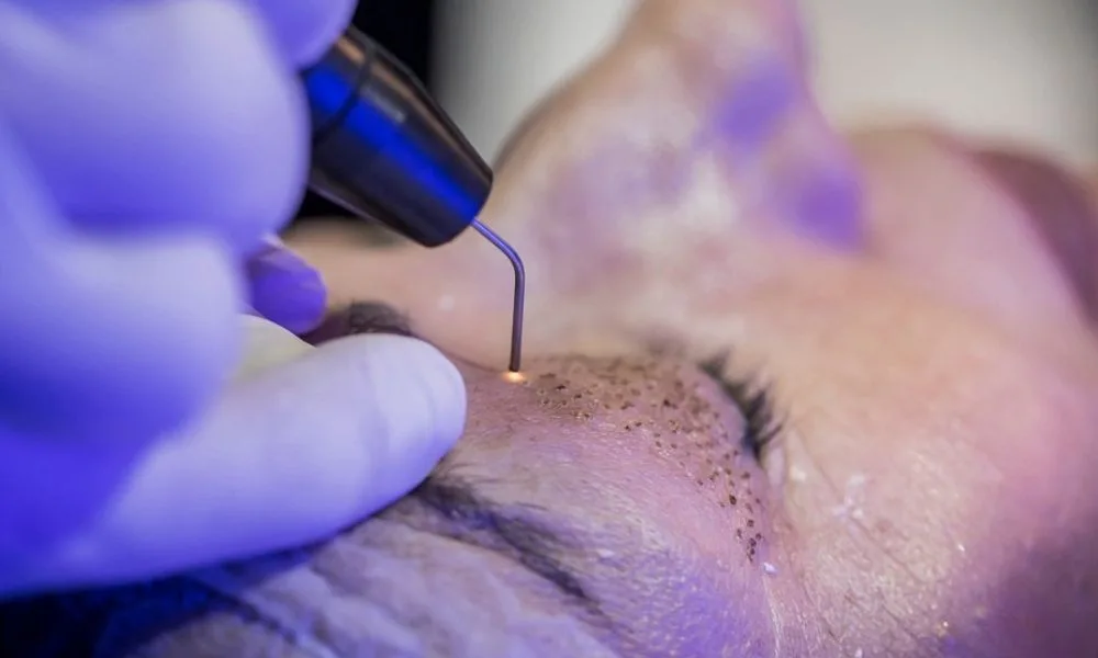 plasmage-ooglidcorrectie