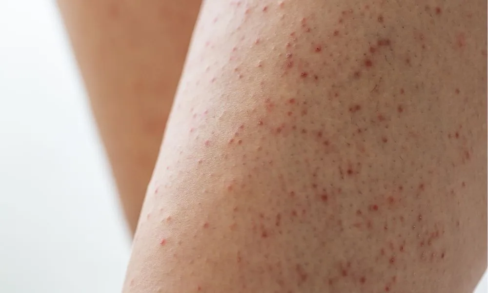 Keratosis pilaris