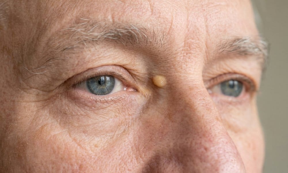 xanthelasma oog man