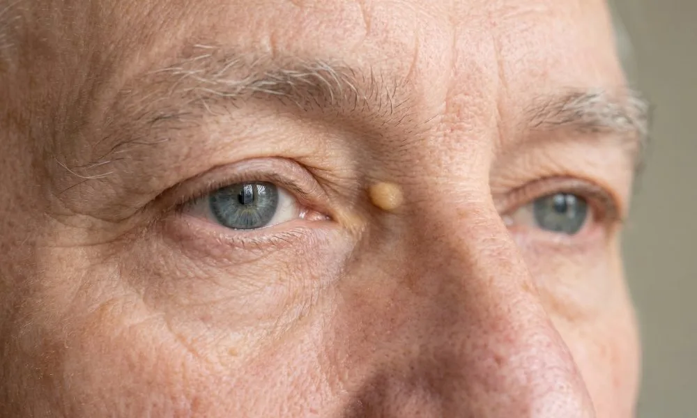 xanthelasma oog man
